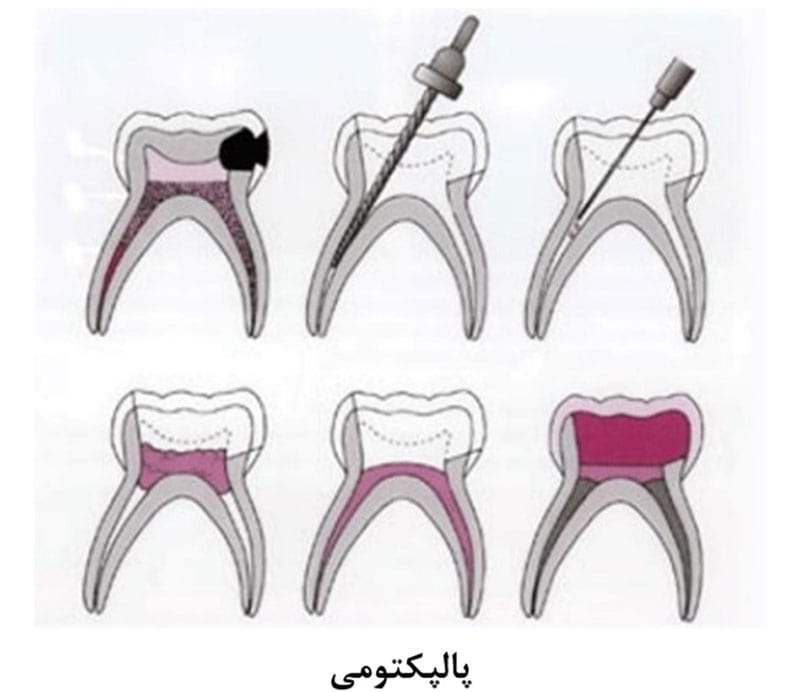 پالپکتومی