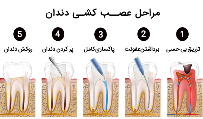 عصب کشی دندان کودکان