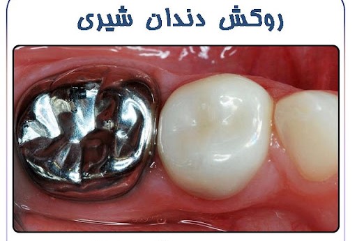 روکش دندان شیری